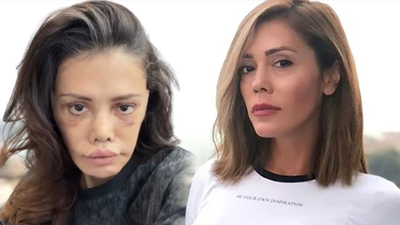 Eski Survivor Yarışmacısı Didem Ceran'dan Yüz Nakli Sonrası Dikkat Çeken Paylaşım