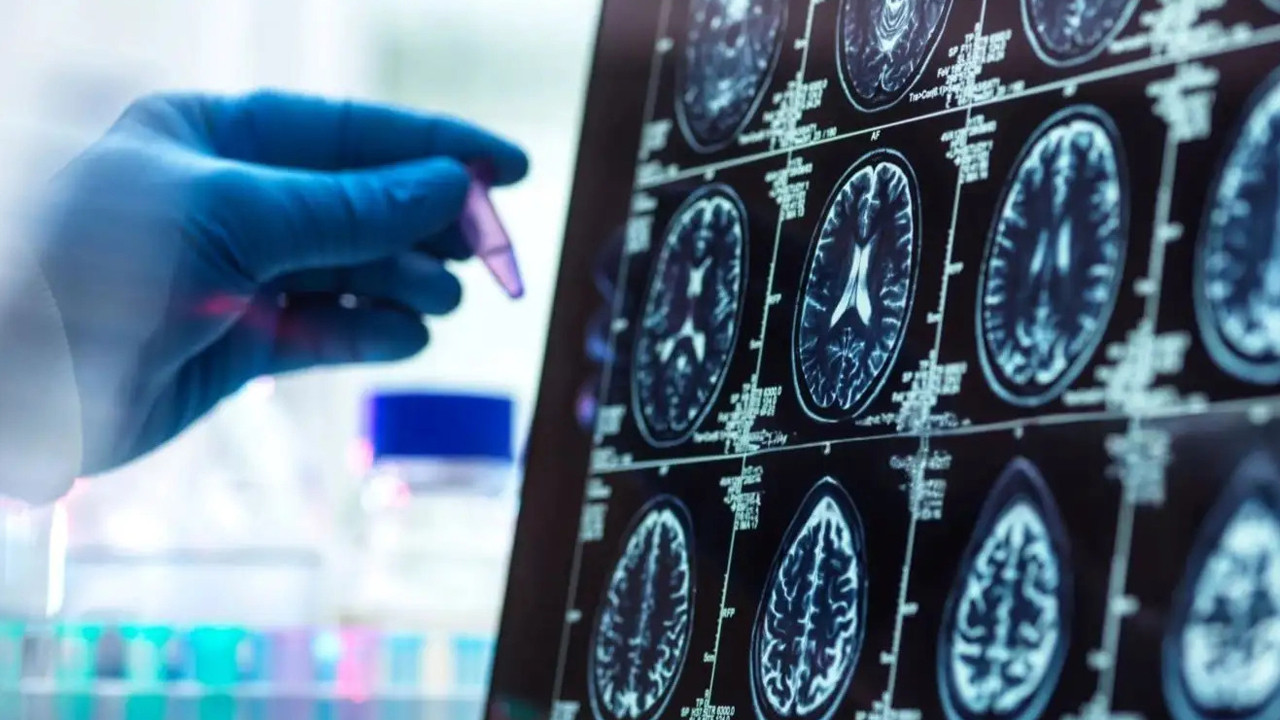 Alzheimer’da 'Gizli Evre' Deşifre Oldu: 50'li Yaşların Sonuna Dikkat