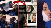 Yüzüne Kızgın Yağ Dökülmüştü... Masterchef Beyza Yüzünün Yanık Halini İlk Kez Paylaştı