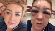 Güzelleşmek İsterken Kabusu Yaşadı! 'Dayak Yemedim, Botoks Mağduruyum'