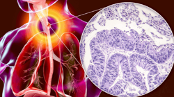 Erkeklerde Daha Çok Görülüyor! İki Belirtiye Dikkat, Kanser Olabilirsiniz