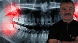 Uzmanından Yirmilik Diş Uyarısı! Geç Kalan Hayatının Hatasını Yapar