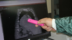 Tıpta Bir İlk: Karadeniz'den Dünyaya Yeni Bir Sendrom