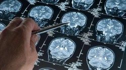 Alzheimer Tedavisinde Devrim Niteliğinde Buluş! Yüzde 95 Oranında Tespit Edebiliyor