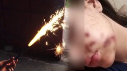 Bayram Günü Maytap Faciası! Genç Kız Kabusu Yaşadı