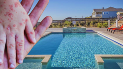 Sessiz Tehlike Havuzda! Çocukları Menenjite Kadar Götüren Virüse Dikkat