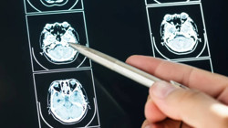 Araştırma: İyimserlerin Beyni Benzer Şekilde Çalışıyor