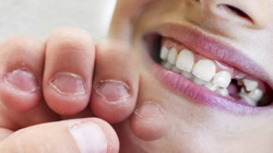 Türkiye'de Her 3 Kişiden 1'inde Görülüyor! Tırnaklardan Başlıyor, Diş Köklerini Eritiyor