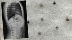 Evde Rahatsızlanan Çocuk Hastanede Herkesi Şoke Etti! Hepsi Boğazından Çıktı