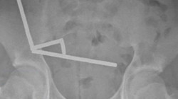 13 Yaşındaki Çocuğun Karnındaki Sır Röntgende Ortaya Çıktı! Tam 100 Tane...