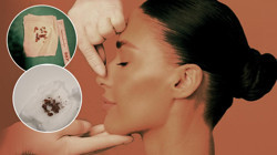 Estetik Ameliyatta Şok Olay: Burundan Taş Çıktı