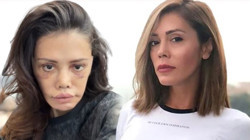 Eski Survivor Yarışmacısı Didem Ceran'dan Yüz Nakli Sonrası Dikkat Çeken Paylaşım