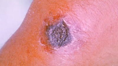 Uzmanlardan şarbon açıklaması: En tehlikelisi...