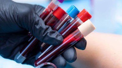 Bu Kan Grubuna Sahip Kişiler Erken Yaşta Alzheimera Yakalanıyor! Risk Almamak İçin Bunları Yapın