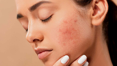 Cilt Kuruluğu, Akne, Tahriş ve Siyah Noktaların Sırrı Buzdolabınızda Gizli: Sadece Bu Malzemeler Yetiyor