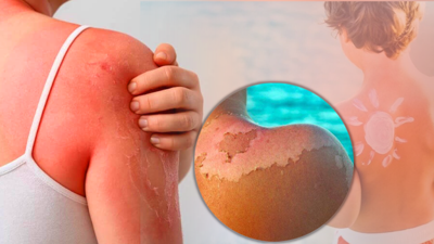 250 Liralık Kabus! Güneş Kreminin Alternatifinde Gizli Tehlike, Vakalar Artabilir