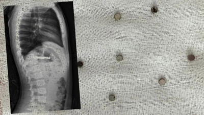 Evde Rahatsızlanan Çocuk Hastanede Herkesi Şoke Etti! Hepsi Boğazından Çıktı