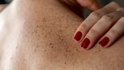 Benlerinizi Sakın Yakmayın! Dermatologdan Hayati Deri Kanseri Uyarısı