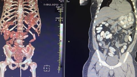 11 kilo uyuşturucuyu midelerinde saklamışlar