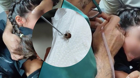 Kulak Ağrısının Nedeni Şok Etti! 5 Yaşındaki Çocuğun Kulağından Kene Çıktı