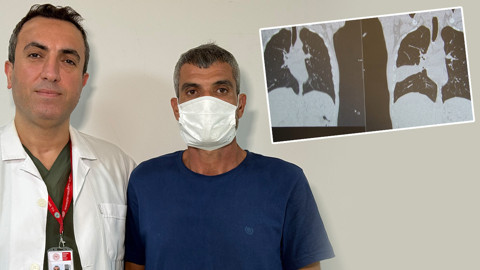 Doktorlar Kanserden Şüphelendi: Geçmeyen Öksürük ve Kilo Kaybıyla Hastaneye Gitti! 41 Yaşındaki Adamın Akciğerinden Kemik Çıktı