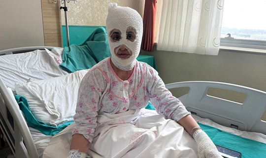 İftar Vakti 'Düdüklü Tencere' Faciası: Bomba Gibi Patladı! 'Yüzüme Dokunduğumda Et Parçası Geliyordu'