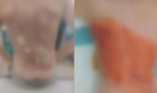 Dehşete Düşüren Akran Zorbalığı! 12 Yaşındaki Çocuğa Kolonya Döküp Ateşe Verdiler