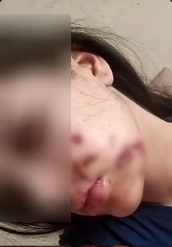 Bayram Günü Maytap Faciası! Genç Kız Kabusu Yaşadı - Resim : 1
