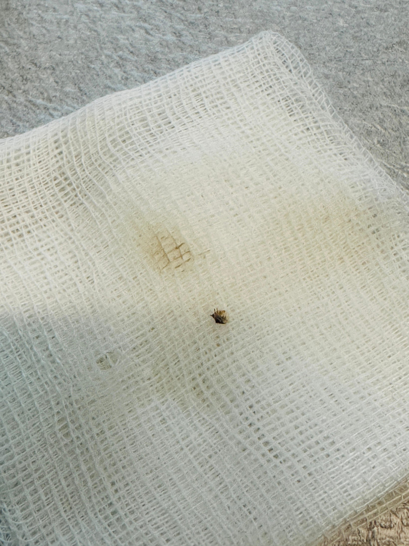 Halsizlik Şikayetiyle Hastaneye Gitti, Karnından Çıkanla Şoke Oldu - Resim : 1