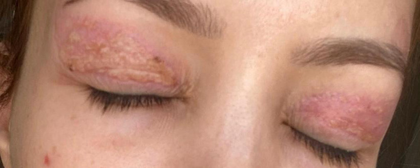 Güzellik Merkezi Kabusu! 1100 Liraya Yaptırdı, 150 Bin Liraya Düzeltilemiyor - Resim : 2