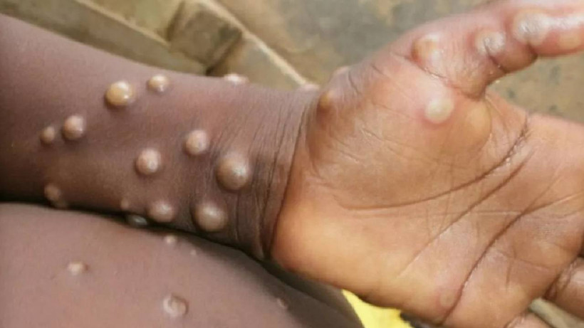 Maymun Çiçeği Bir Ülkeye Daha Sıçradı, Hasta Turist Tedavi Altına Alındı