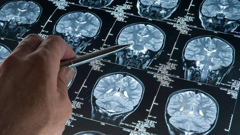 Alzheimer Tedavisinde Devrim Niteliğinde Buluş! Yüzde 95 Oranında Tespit Edebiliyor