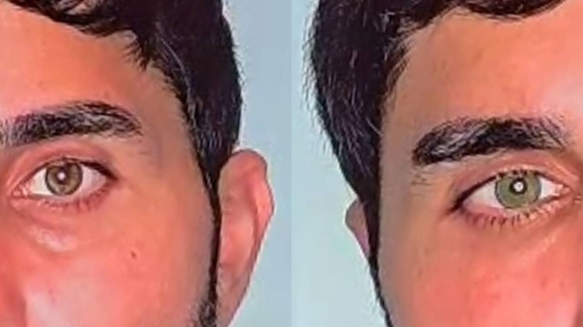 Mavi mi, Yeşil mi? Lazerle Göz Rengini Değiştirme Dönemi Başladı