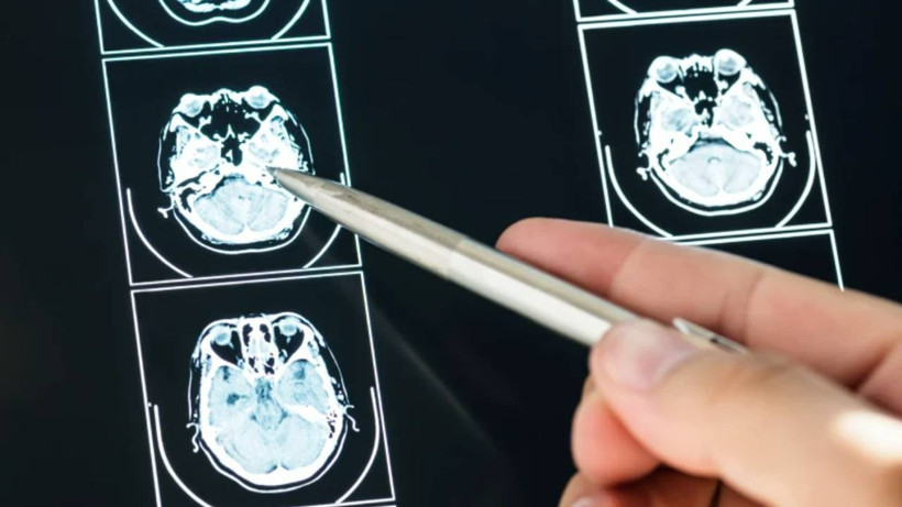 Araştırma: İyimserlerin Beyni Benzer Şekilde Çalışıyor