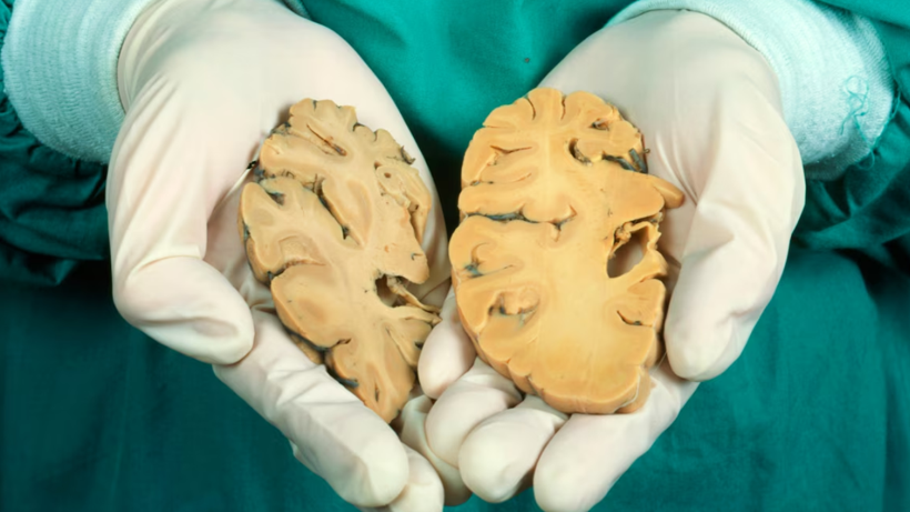 Harvard’dan Alzheimer’ı Geri Döndüren Keşif! Bilim Dünyası Yeni Bir Döneme Kapı Araladı