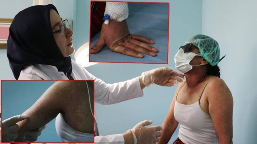 İnternetten Aldığı Kremde Kezzap Etkili Madde Çıktı! Bütün Hayatı Karardı