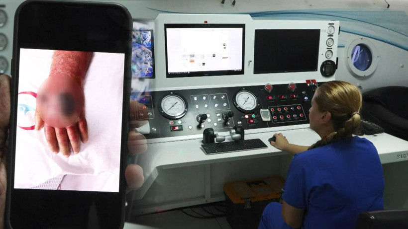 Hırsızın Isırdığı Eli Amputasyondan Döndü! Nadir Görülen Vaka Literatüre Giriyor