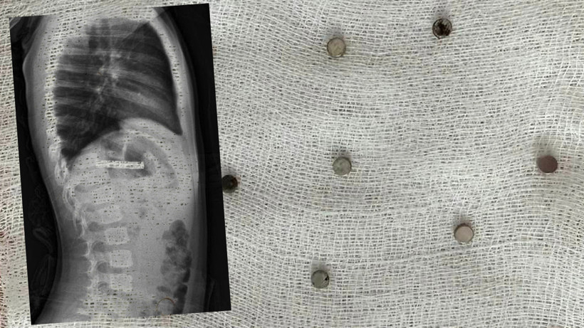 Evde Rahatsızlanan Çocuk Hastanede Herkesi Şoke Etti! Hepsi Boğazından Çıktı