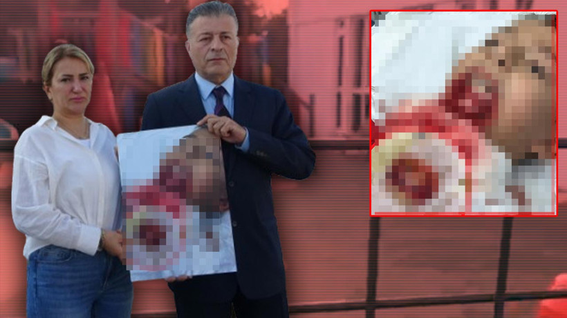 Okulda Demir Çit Faciası! Küçük Kuzey'in Çenesi Koptu