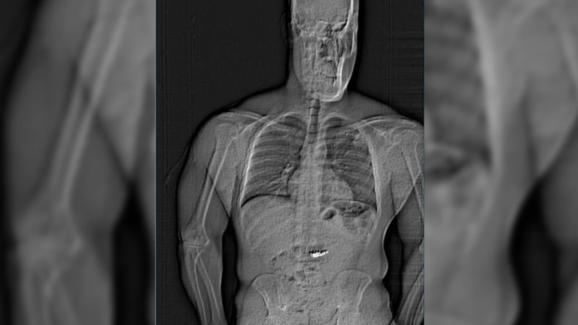 Polisi de Hırsızı da Alarma Geçirdi: Midesinde 28 Milyon 200 Bin Liralık Servet Taşıyor! - Resim: 4