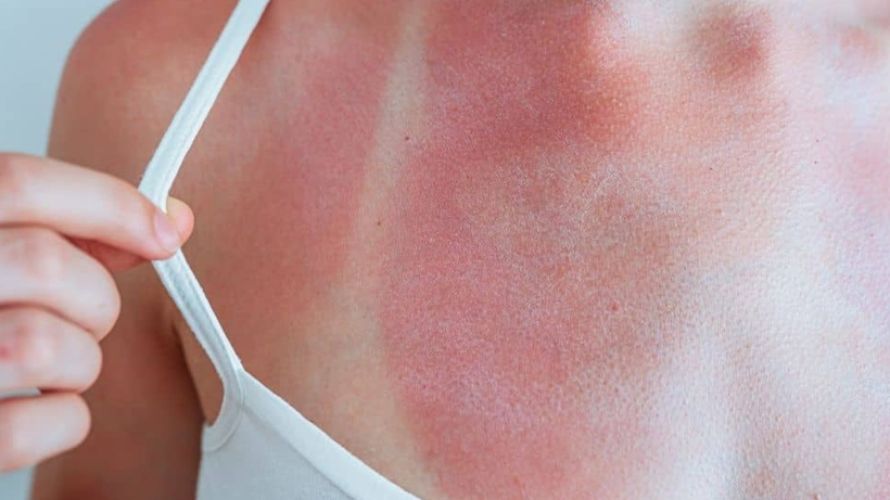 250 Liralık Kabus! Güneş Kreminin Alternatifinde Gizli Tehlike, Vakalar Artabilir - Resim : 3