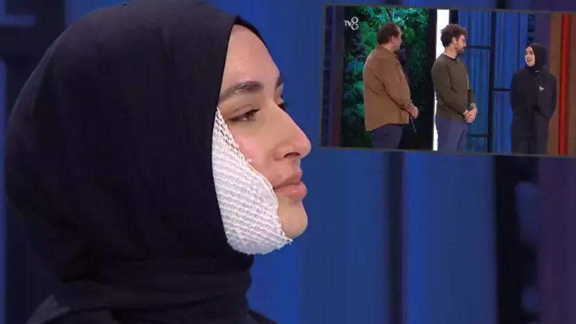 Yüzüne Kızgın Yağ Dökülmüştü... Masterchef Beyza Yüzünün Yanık Halini İlk Kez Paylaştı - Resim : 1