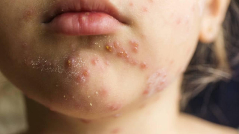 10 Yıl Sonra Yeniden Hortladı, Panik Büyüyor! Art Arda Can Kayıpları Geldi - Resim : 1