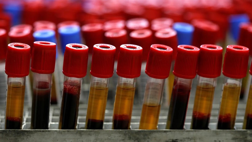 Bu Kan Grubuna Sahip Kişiler Erken Yaşta Alzheimera Yakalanıyor! Risk Almamak İçin Bunları Yapın - Resim : 1