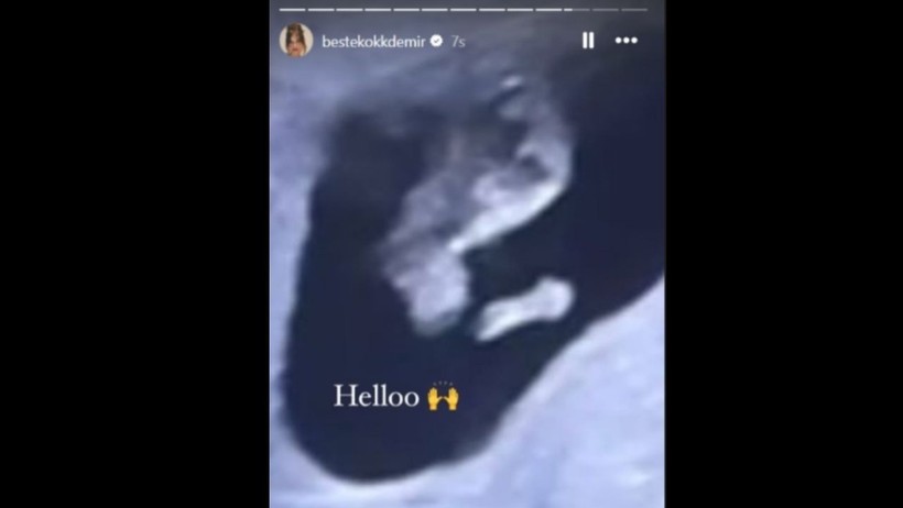 Ekranların Gözdesi Beste Kökdemir İlk Bebek Heyecanını Paylaştı - Resim : 2