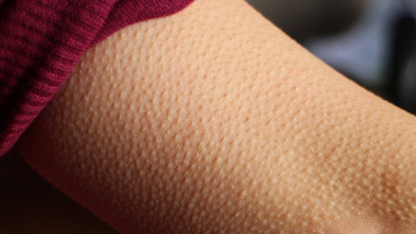 Tüylerin Diken Diken Olmasının Asıl Sebebi Ortaya Çıktı: Bilim İlk Kez Açıkladı - Resim : 1