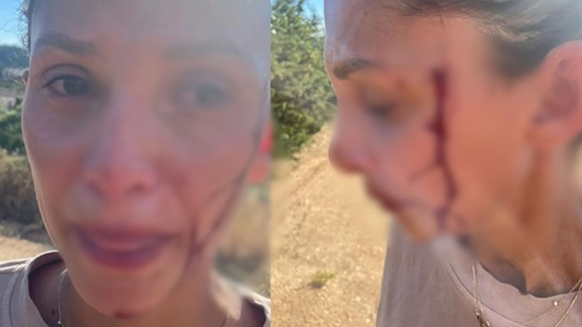 Can Yaman’ın Sevgilisinden Korkunç İtiraf! Kanlar İçinde Fotoğraflarını Paylaştı, Ortalık Karıştı - Resim : 2