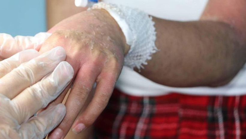 İnternetten Aldığı Kremde Kezzap Etkili Madde Çıktı! Bütün Hayatı Karardı - Resim : 3