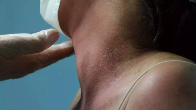 İnternetten Aldığı Kremde Kezzap Etkili Madde Çıktı! Bütün Hayatı Karardı - Resim : 4