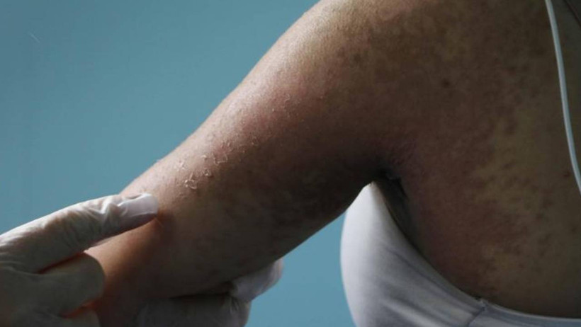 İnternetten Aldığı Kremde Kezzap Etkili Madde Çıktı! Bütün Hayatı Karardı - Resim : 2